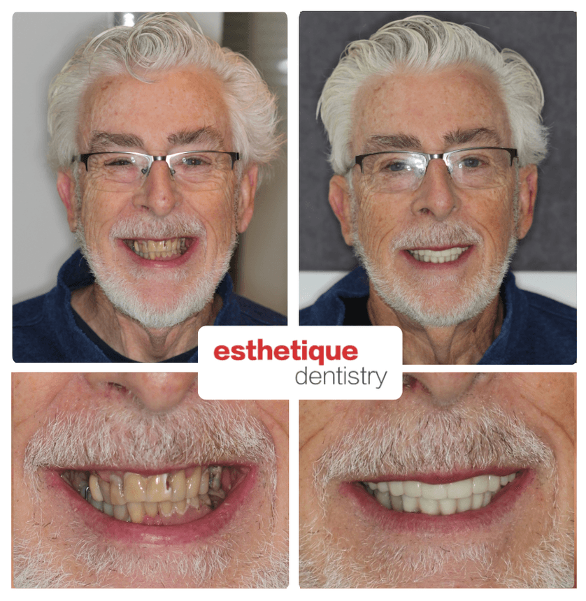 Before and after — Bill M.