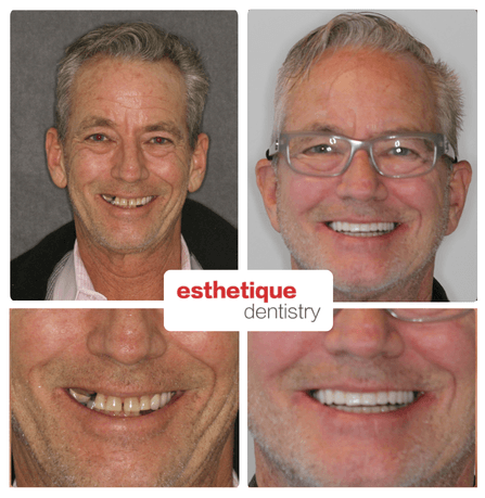 Before and after - Bill K.