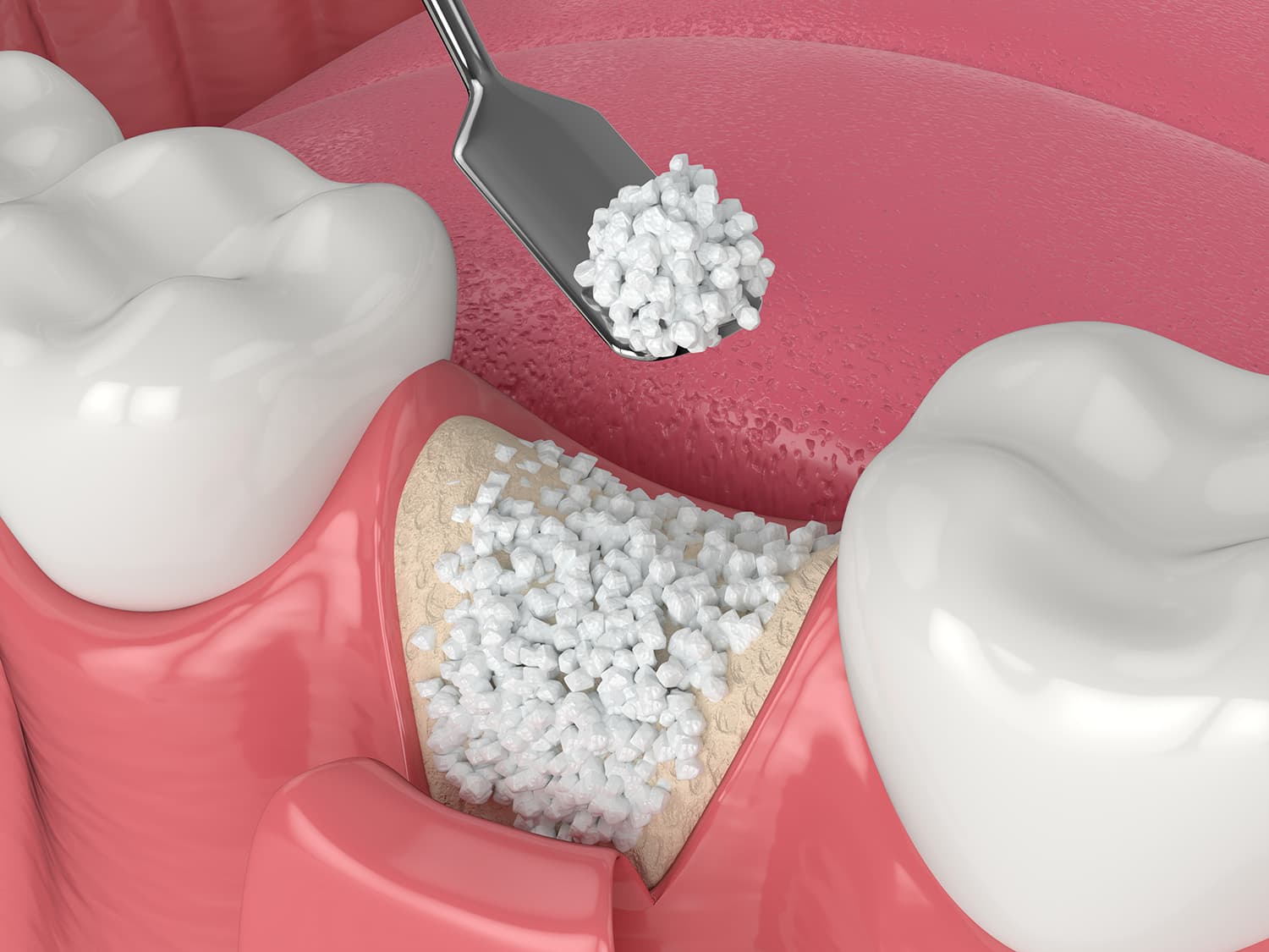 3D illustration of dental bone grafting procedure showing bone graft material being placed in Ashburn VA