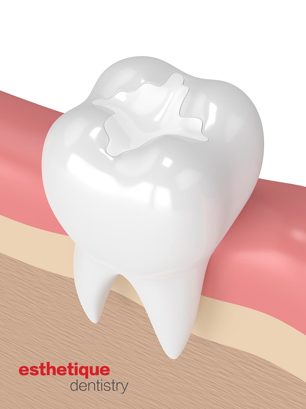 3D illustration of tooth-colored dental filling on a molar tooth in Ashburn VA