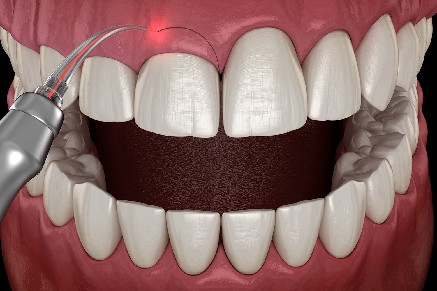 3D illustration of laser gum contouring procedure in Ashburn VA