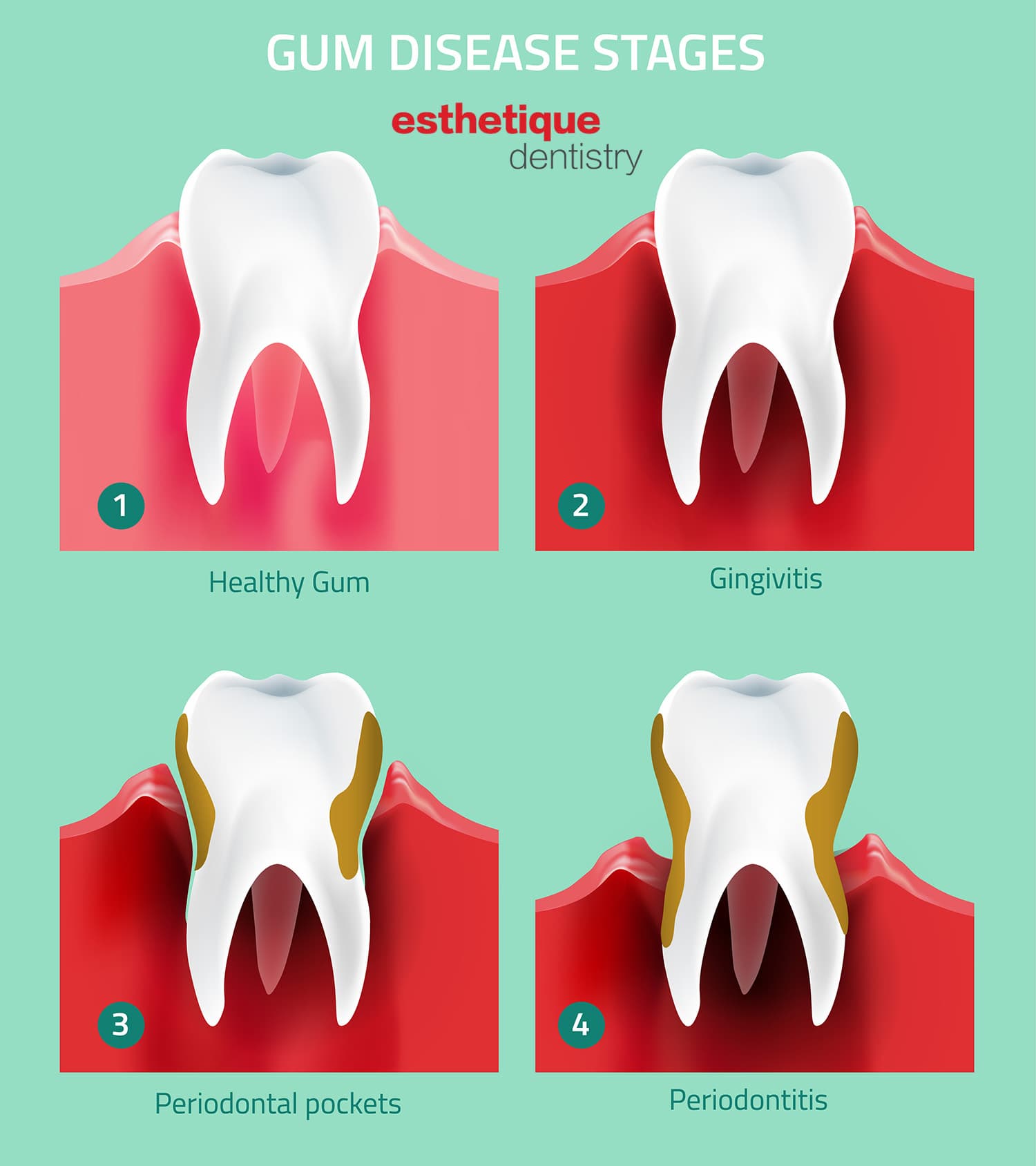 Gum disease stages infographic showing healthy gum, gingivitis, periodontal pockets, and periodontitis