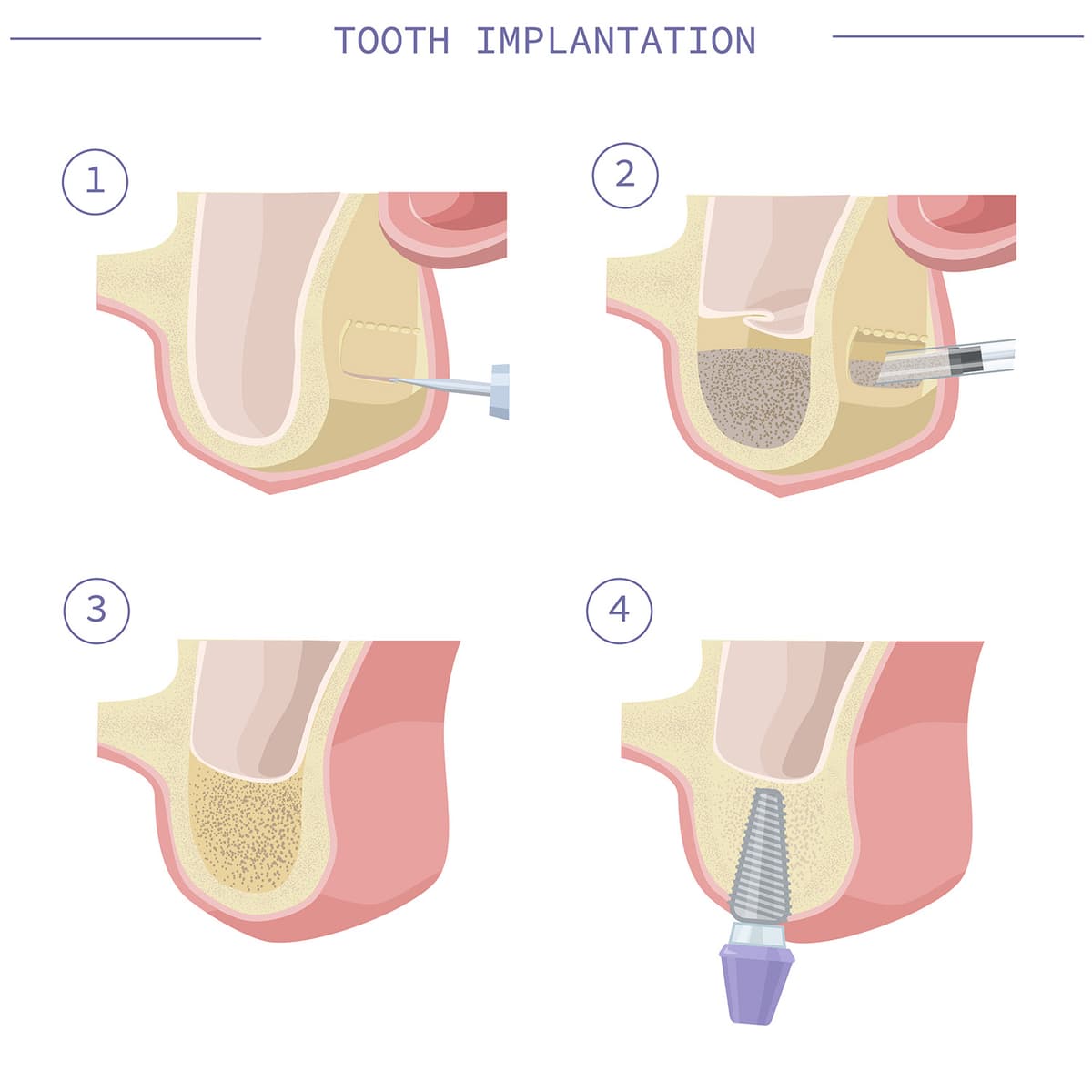 Sinus lift procedure diagram showing 4 steps: accessing the sinus, placing bone graft material, healing integration, and final dental implant placement